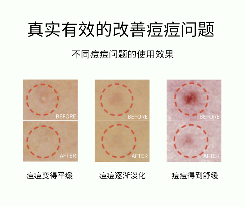 祛痘贴详情_09.jpg